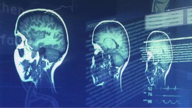 英特尔AI医疗实战曝光：10倍加速辅助诊断、准确度高达90%