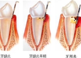 牙周炎怎么治疗