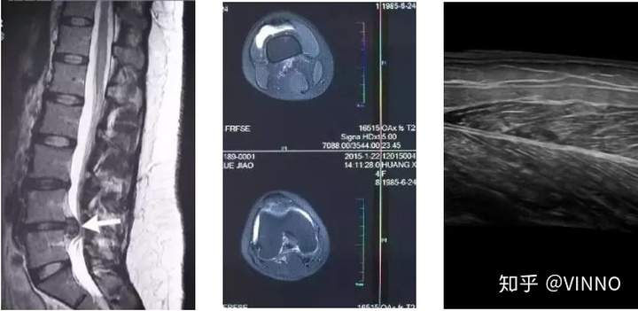 手机怎么拍摄x射线ct与x光的哪个辐射大_一篇读懂｜X光／CT／核磁／B超分别看什么，有没有辐射？_https://www.jmylbn.com_新闻资讯_第2张