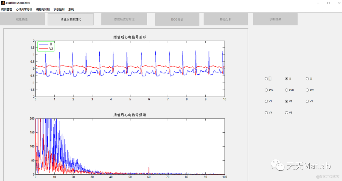 心电图自动诊断系统附GUI界面_方差_02