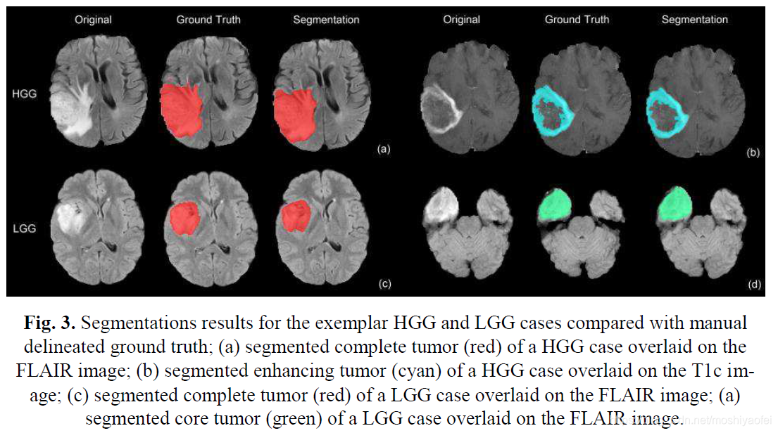 Automatic Brain Tumor Detection and Segmentation Using U-Net Based ...