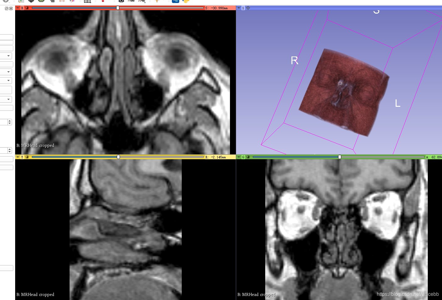超级简单的3D slicer教程（三）creating label Map_3d slicer roi删除-CSDN博客