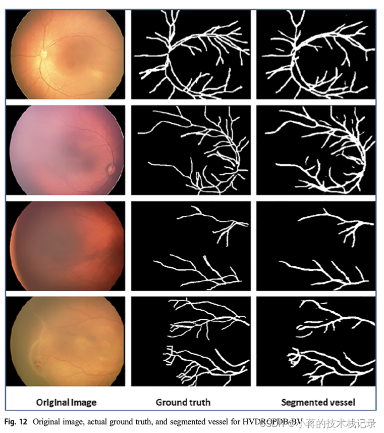 Deep dive in retinal fundus image segmentation using deep learning for ...