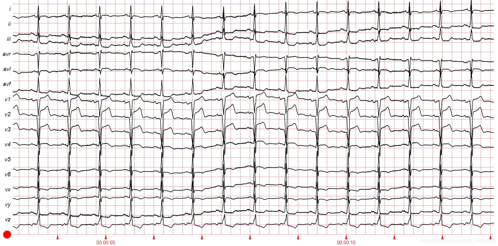 cms导联是什么Deep Learning × ECG (1) :关于心律失常ECG的基础常识-上海聚慕医疗器械有限公司