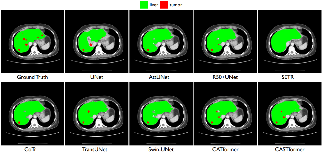 Visual comparisons with other methods on LiTS dataset