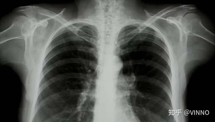 手机怎么拍摄x射线ct与x光的哪个辐射大_一篇读懂｜X光／CT／核磁／B超分别看什么，有没有辐射？_https://www.jmylbn.com_新闻资讯_第7张