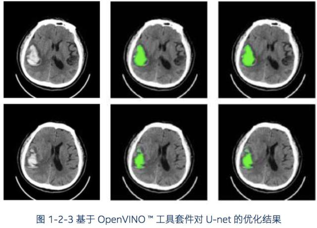 英特尔AI医疗实战曝光：10倍加速辅助诊断、准确度高达90%