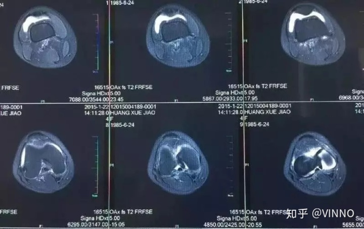 手机怎么拍摄x射线ct与x光的哪个辐射大_一篇读懂｜X光／CT／核磁／B超分别看什么，有没有辐射？_https://www.jmylbn.com_新闻资讯_第5张