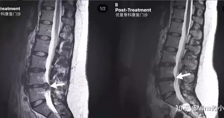 手机怎么拍摄x射线ct与x光的哪个辐射大_一篇读懂｜X光／CT／核磁／B超分别看什么，有没有辐射？_https://www.jmylbn.com_新闻资讯_第4张