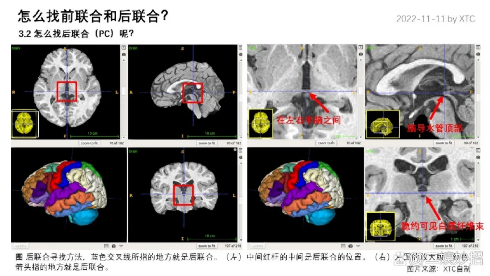 大脑的前联合在哪个位置_大脑前联合与后联合定义-CSDN博客