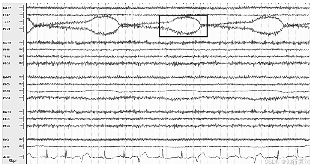 心电图机通道怎么分类「EEG脑电信号处理——（17）EEG常见伪差（Artifact）分类、识别与处理」2026年03月11日_https://www.jmylbn.com_新闻资讯_第2张