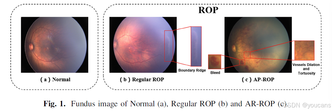 【医学影像 AI】基于深度卷积网络的 AP-ROP 病变的自动诊断-CSDN博客