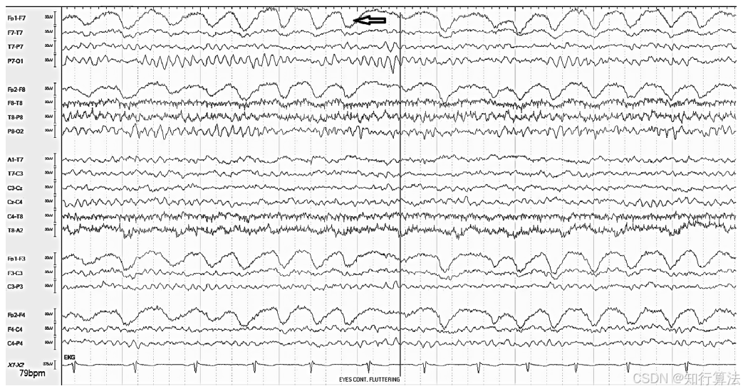 心电图机通道怎么分类「EEG脑电信号处理——（17）EEG常见伪差（Artifact）分类、识别与处理」2026年03月11日_https://www.jmylbn.com_新闻资讯_第8张