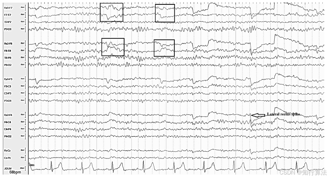 心电图机通道怎么分类「EEG脑电信号处理——（17）EEG常见伪差（Artifact）分类、识别与处理」2026年03月11日_https://www.jmylbn.com_新闻资讯_第9张