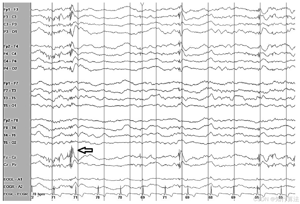 心电图机通道怎么分类「EEG脑电信号处理——（17）EEG常见伪差（Artifact）分类、识别与处理」2026年03月11日_https://www.jmylbn.com_新闻资讯_第19张