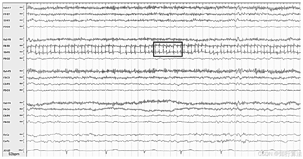 心电图机通道怎么分类「EEG脑电信号处理——（17）EEG常见伪差（Artifact）分类、识别与处理」2026年03月11日_https://www.jmylbn.com_新闻资讯_第1张