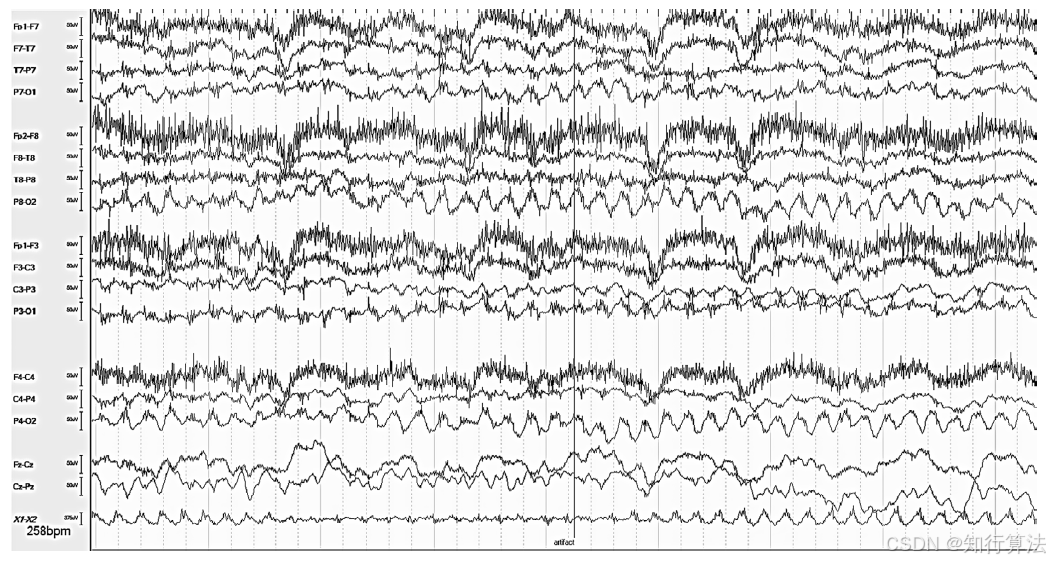 心电图机通道怎么分类「EEG脑电信号处理——（17）EEG常见伪差（Artifact）分类、识别与处理」2026年03月11日_https://www.jmylbn.com_新闻资讯_第20张