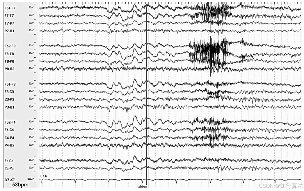 心电图机通道怎么分类「EEG脑电信号处理——（17）EEG常见伪差（Artifact）分类、识别与处理」2026年03月11日_https://www.jmylbn.com_新闻资讯_第13张