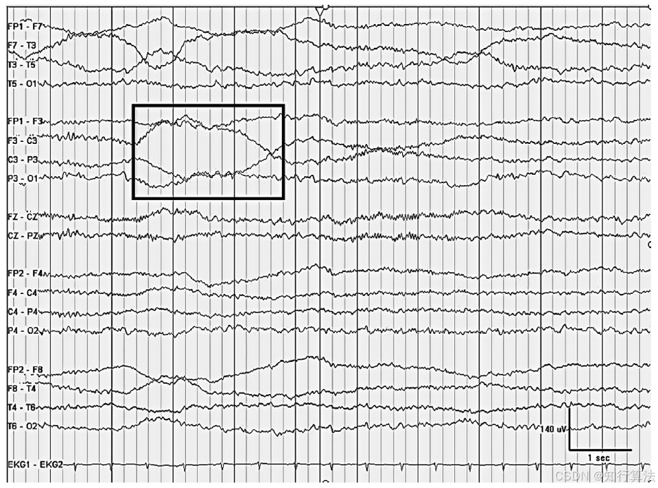 心电图机通道怎么分类「EEG脑电信号处理——（17）EEG常见伪差（Artifact）分类、识别与处理」2026年03月11日_https://www.jmylbn.com_新闻资讯_第3张