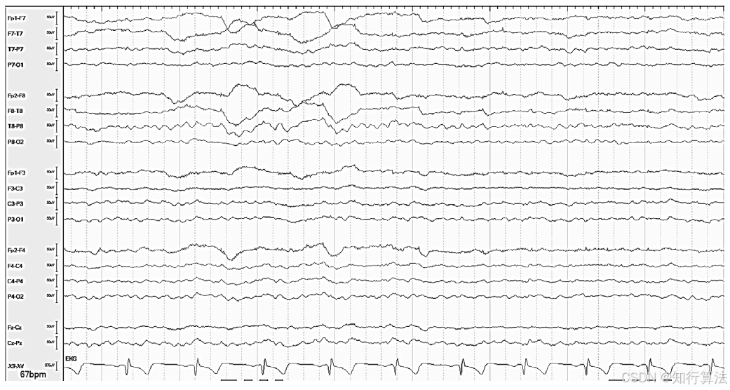心电图机通道怎么分类「EEG脑电信号处理——（17）EEG常见伪差（Artifact）分类、识别与处理」2026年03月11日_https://www.jmylbn.com_新闻资讯_第11张