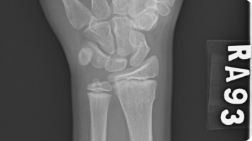 深度学习实战-基于ConvMixer的骨折X光图像分类识别模型