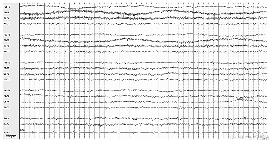 心电图机通道怎么分类「EEG脑电信号处理——（17）EEG常见伪差（Artifact）分类、识别与处理」2026年03月11日_https://www.jmylbn.com_新闻资讯_第12张