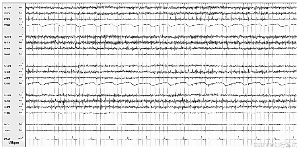 心电图机通道怎么分类「EEG脑电信号处理——（17）EEG常见伪差（Artifact）分类、识别与处理」2026年03月11日_https://www.jmylbn.com_新闻资讯_第16张