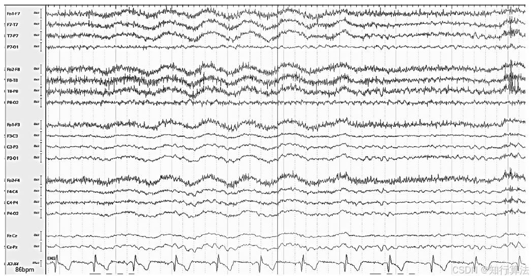 心电图机通道怎么分类「EEG脑电信号处理——（17）EEG常见伪差（Artifact）分类、识别与处理」2026年03月11日_https://www.jmylbn.com_新闻资讯_第14张