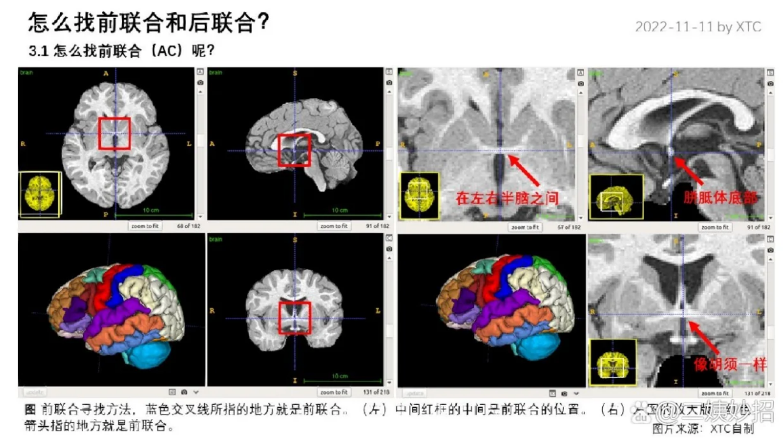 大脑的前联合在哪个位置_大脑前联合与后联合定义-CSDN博客