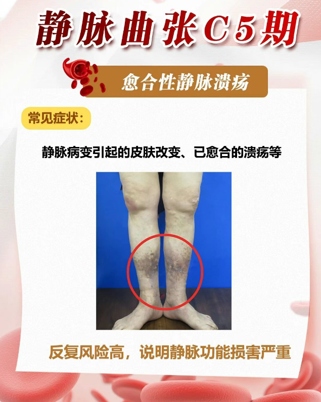静脉曲张第五期症状特征-CSDN博客