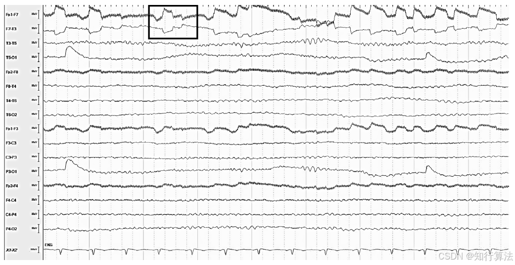 心电图机通道怎么分类「EEG脑电信号处理——（17）EEG常见伪差（Artifact）分类、识别与处理」2026年03月11日_https://www.jmylbn.com_新闻资讯_第10张