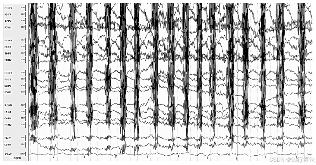 心电图机通道怎么分类「EEG脑电信号处理——（17）EEG常见伪差（Artifact）分类、识别与处理」2026年03月11日_https://www.jmylbn.com_新闻资讯_第18张