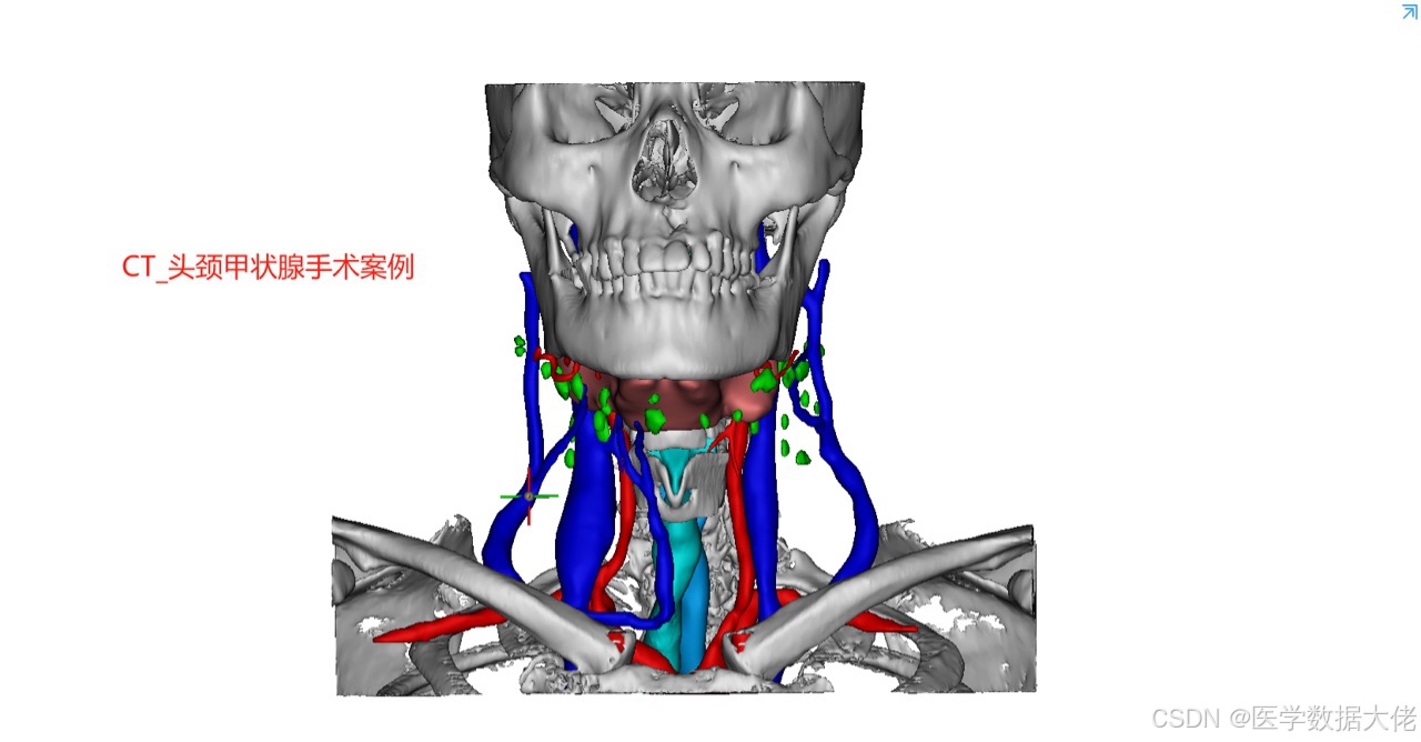 甲状腺　模型 64508fig02large.jpg