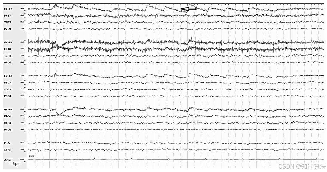心电图机通道怎么分类「EEG脑电信号处理——（17）EEG常见伪差（Artifact）分类、识别与处理」2026年03月11日_https://www.jmylbn.com_新闻资讯_第7张