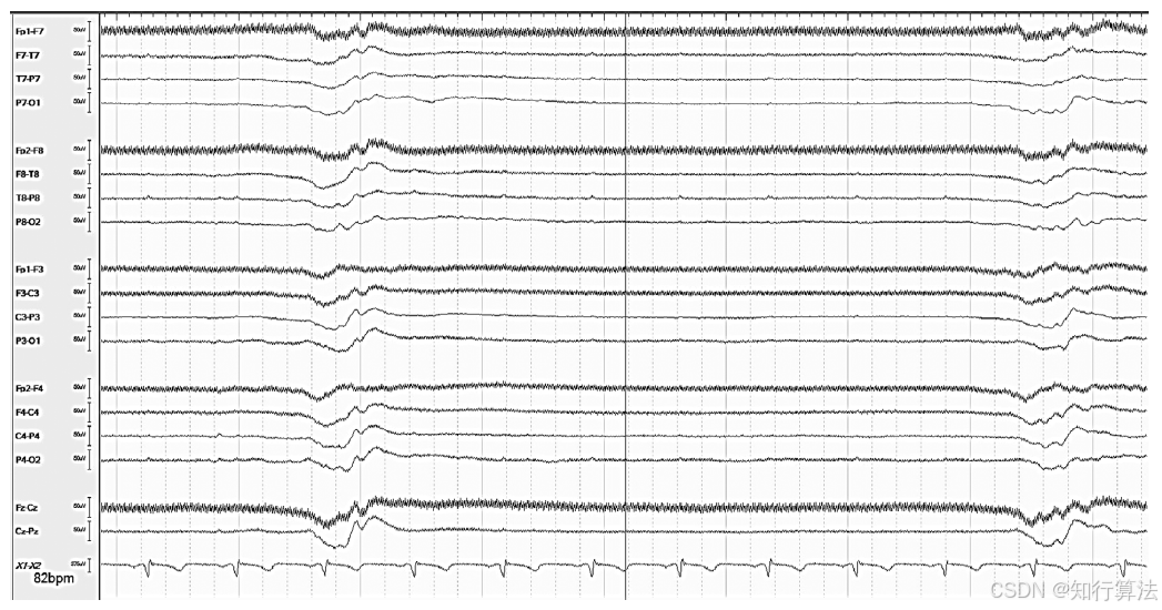 心电图机通道怎么分类「EEG脑电信号处理——（17）EEG常见伪差（Artifact）分类、识别与处理」2026年03月11日_https://www.jmylbn.com_新闻资讯_第4张