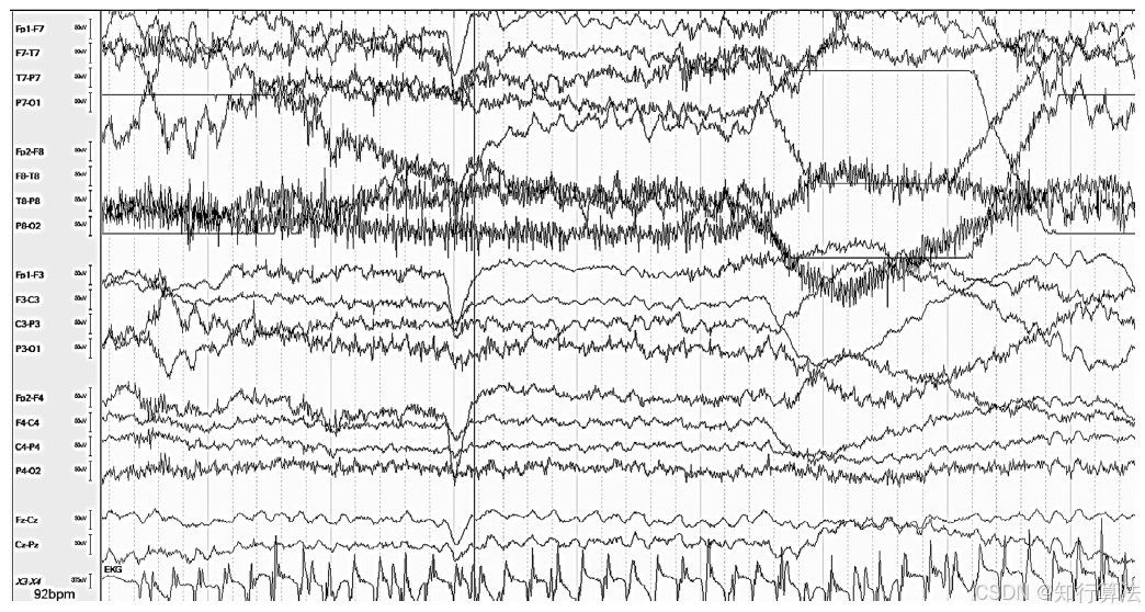 心电图机通道怎么分类「EEG脑电信号处理——（17）EEG常见伪差（Artifact）分类、识别与处理」2026年03月11日_https://www.jmylbn.com_新闻资讯_第5张