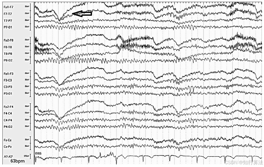 心电图机通道怎么分类「EEG脑电信号处理——（17）EEG常见伪差（Artifact）分类、识别与处理」2026年03月11日_https://www.jmylbn.com_新闻资讯_第6张