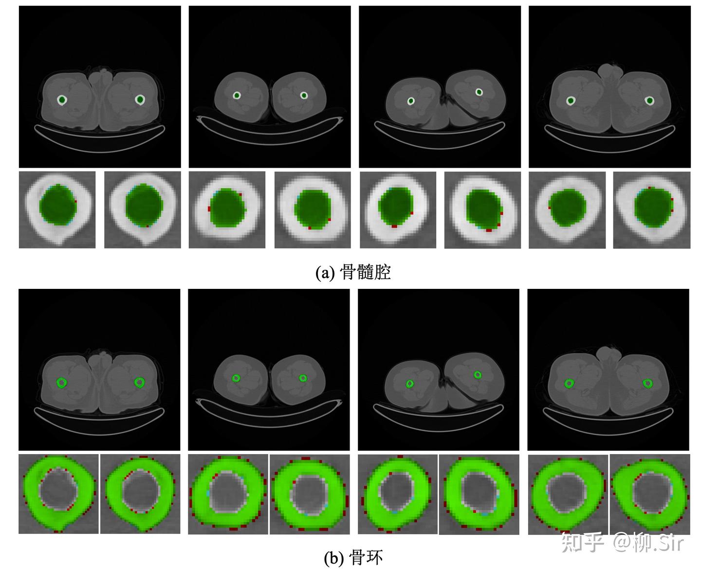 图16:腿骨分割结果可视化