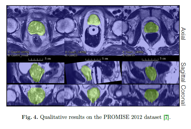 【论文阅读】V-Net：Fully Convolutional Neural Networks for Volumetric Medical ...
